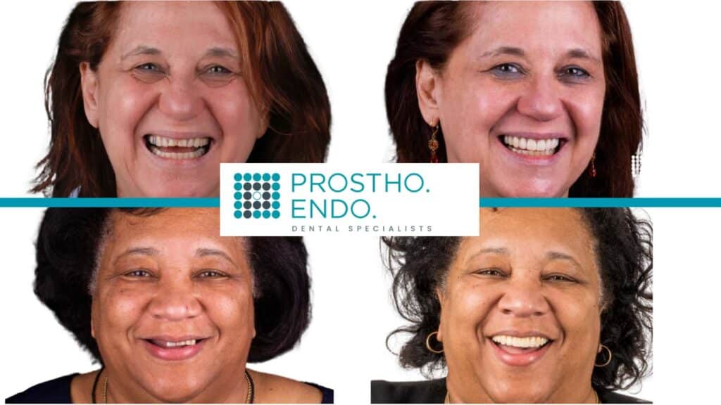 Prostho Dental All on 4 Before and After