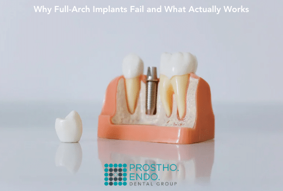 full arch implants prostho endo dental group