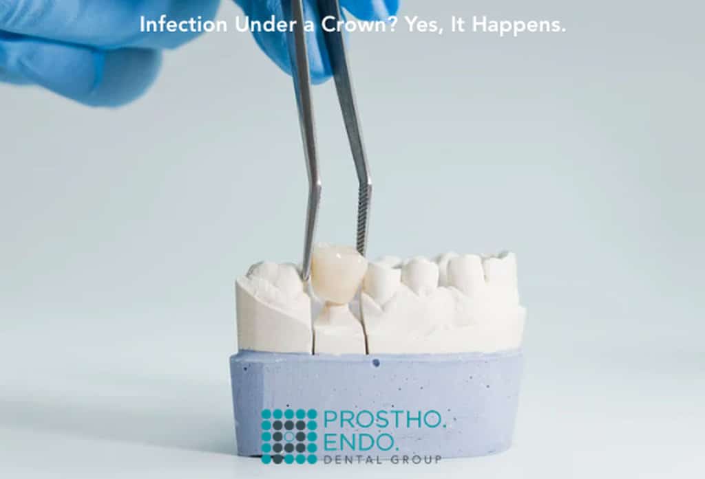 How Can a Dentist Tell If Your Tooth Is Infected Under an Existing Crown?