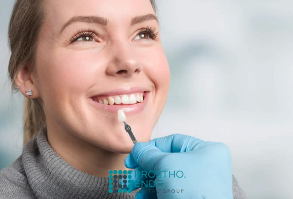 Natural looking veneers prostho endo dental group