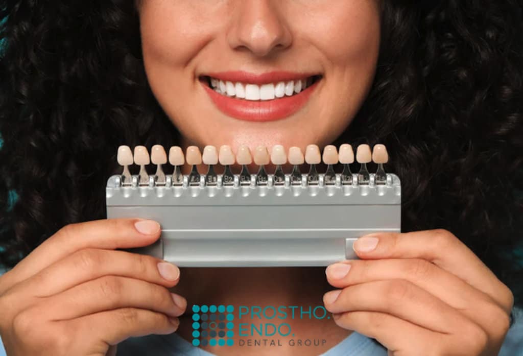Dental Veneers Process Prostho Endo Dental Group