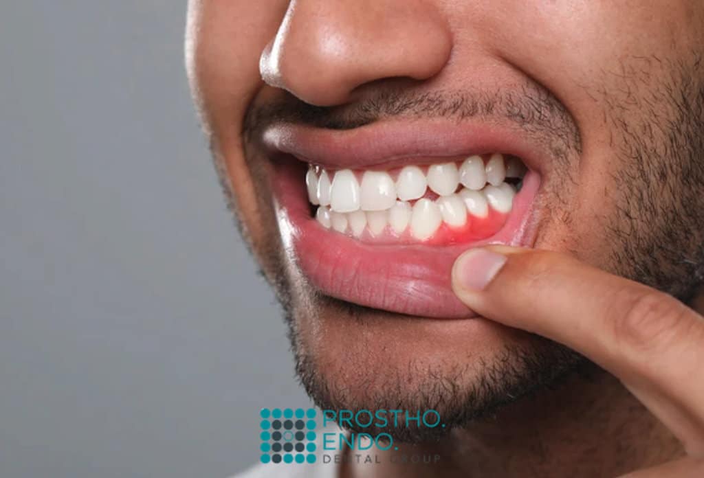 Gum Contouring Prostho Endo Dental Group