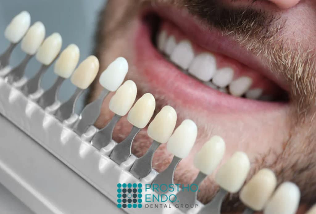 Veneers material Prostho Endo Dental Group