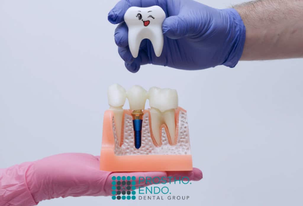 Single or Multiple Implants prostho endo dental group