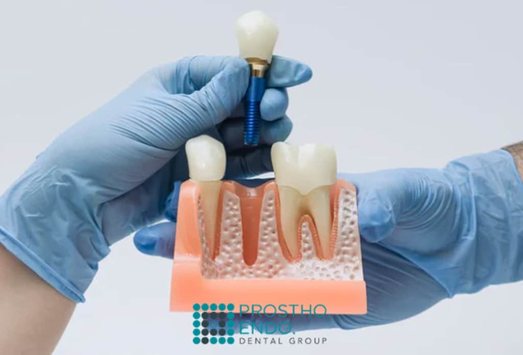 dental implant stability prostho endo dental group