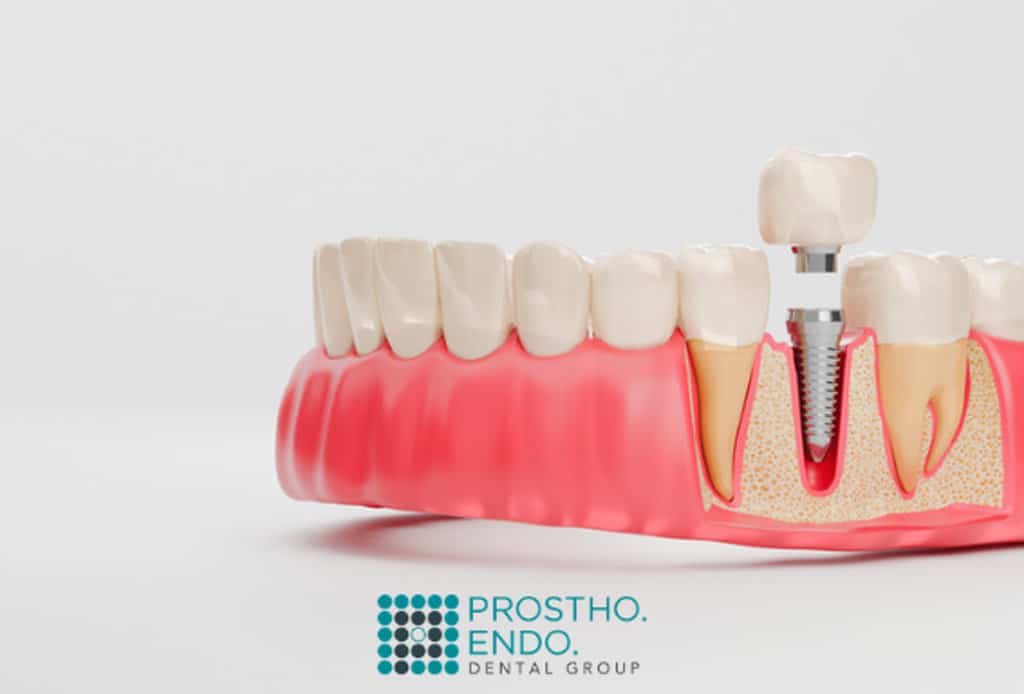 Dental Implants FAQS prostho endo dental group
