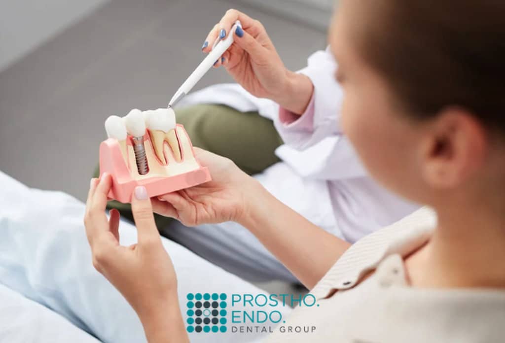 Dental implants cost prostho endo dental group