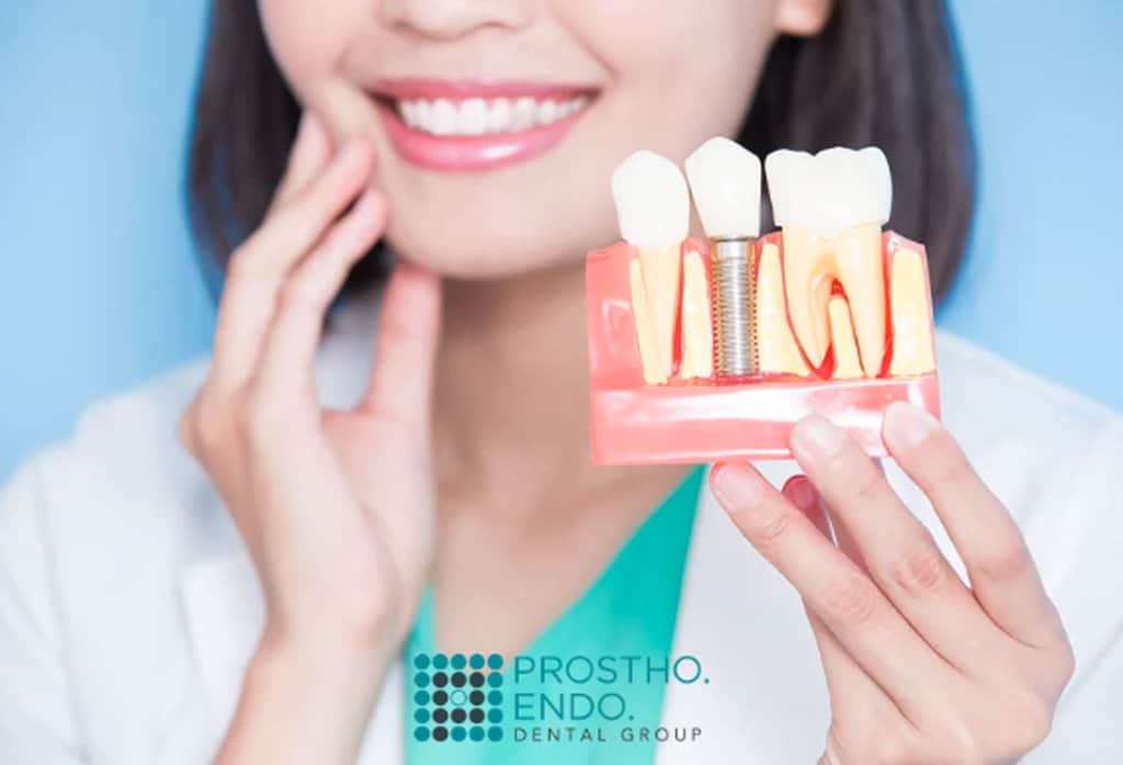 Dental implants for missing teeth prostho endo dental group