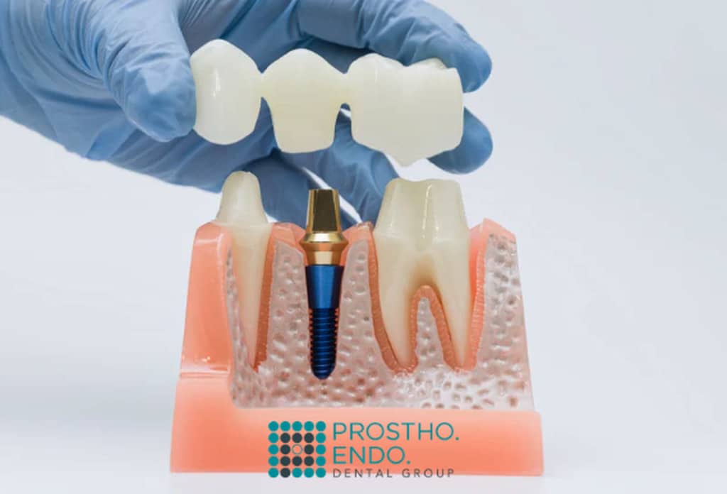 Guided dental implants prostho endo dental group